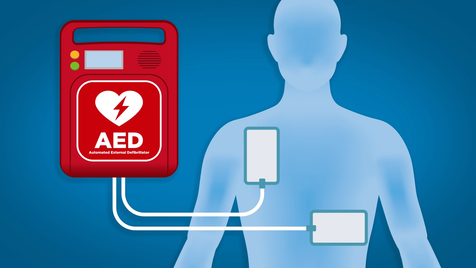 aed-the-critical-bridge-in-cardiac-survival
