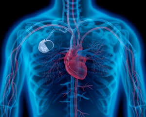 modern-pacemakers-technology-and-clinical-benefits