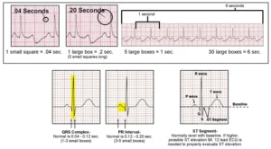 ecg-basics-understanding-heart-electrical-activity